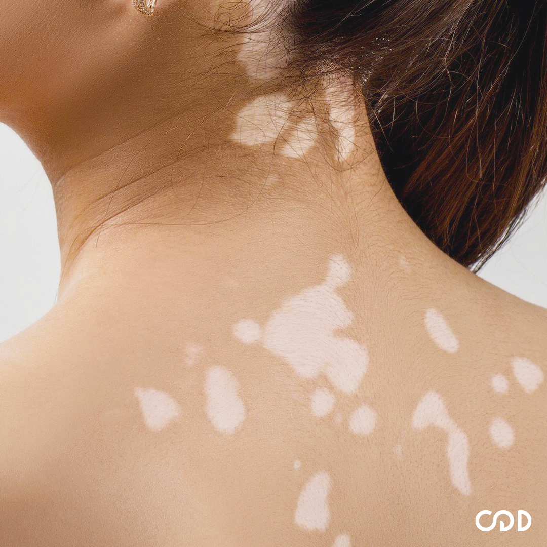 O que é vitiligo? Entenda mais sobre a condição que acompanha a Natália do BBB22